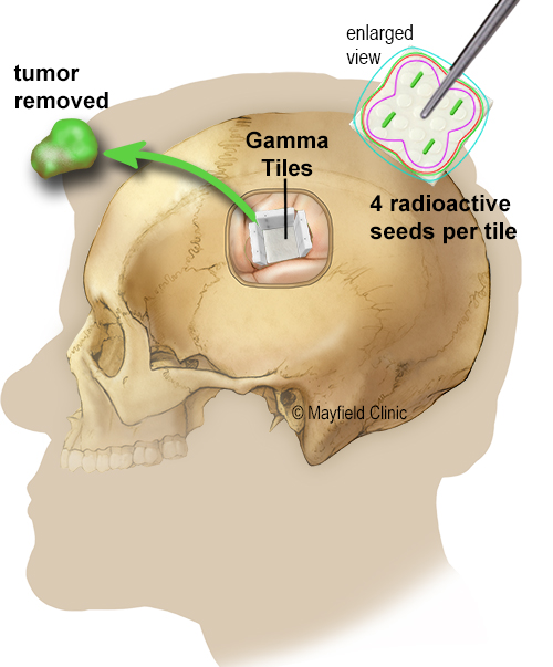 GammaTile