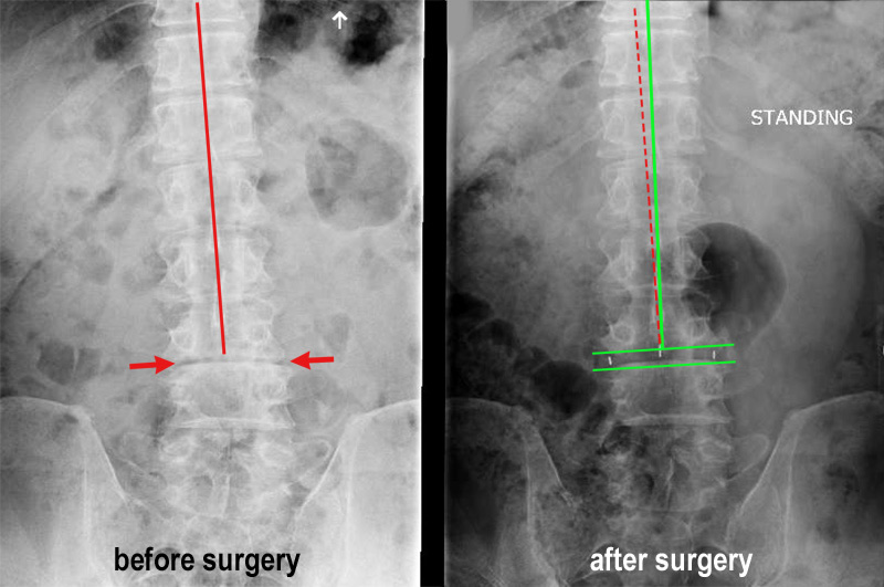 Spinal Stenosis Injections: Never Trust a Back MRI! - Wasatch Pain Solutions