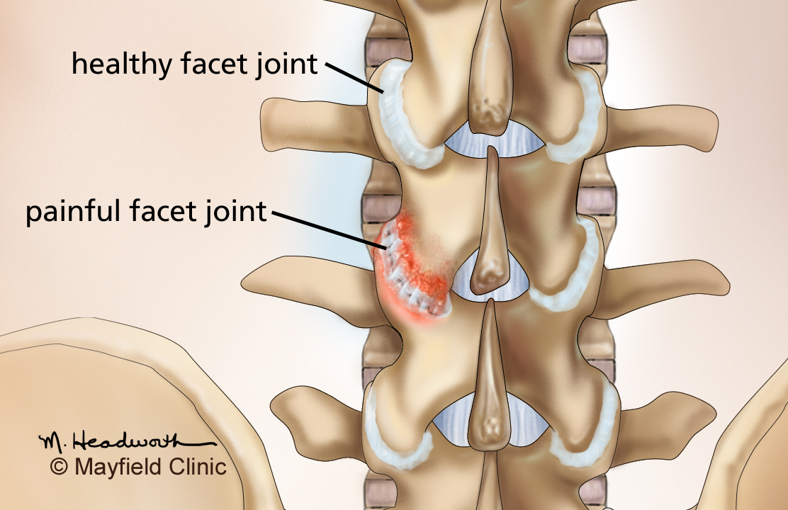 when-back-pain-doesn-t-get-better-webinar-explores-the-when-why-and