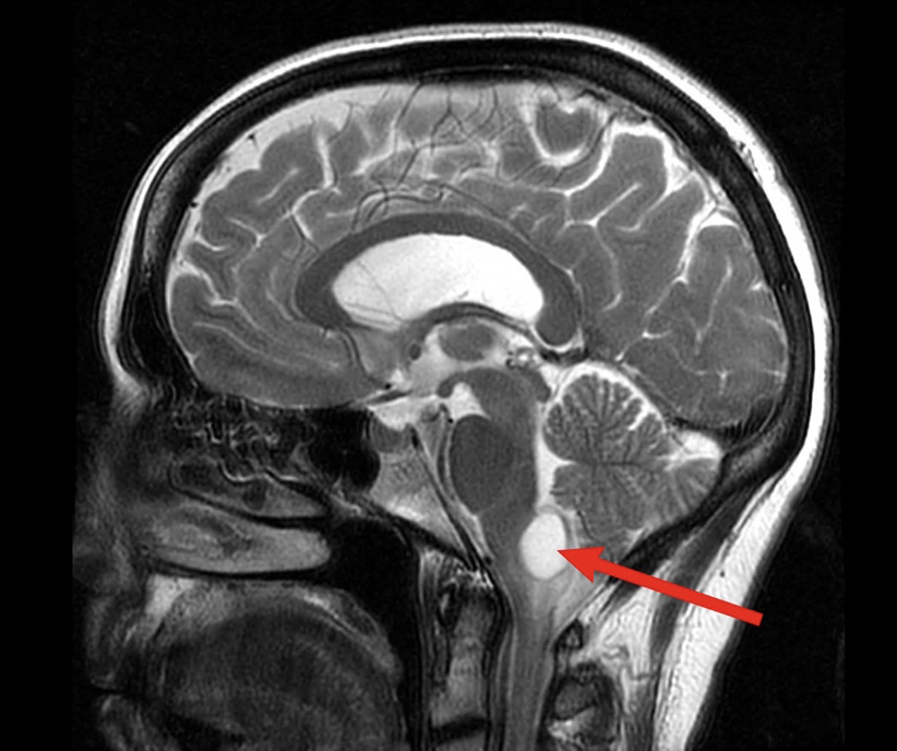 tumor on brain stem