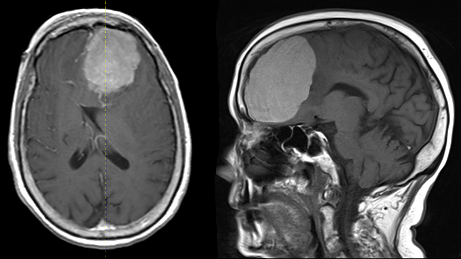 An MRI showing the size and location of the tumor