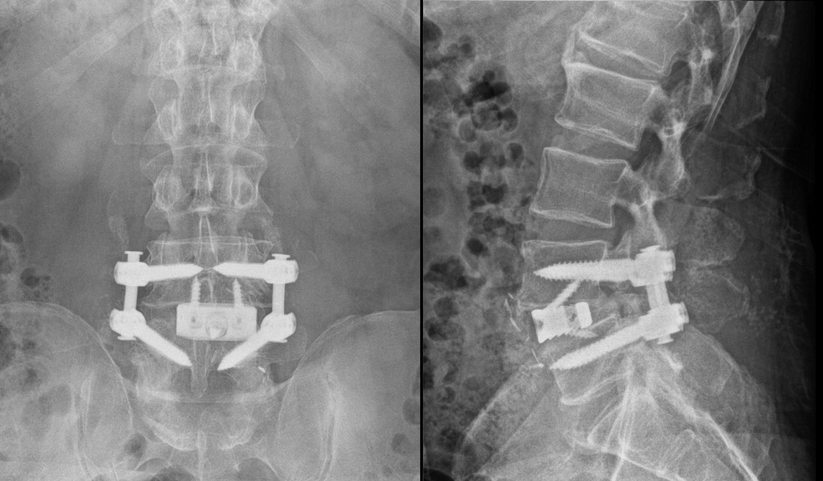 Photo of Jeff's post op