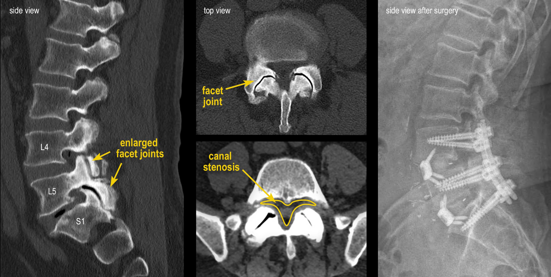 Before and after imaging of Jim's spine