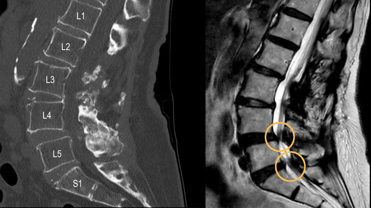 Mary's scans showning nerve compression in the lumbar spine