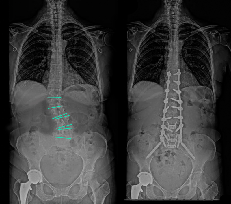 X-rays showing Terry's spine before and after surgery 