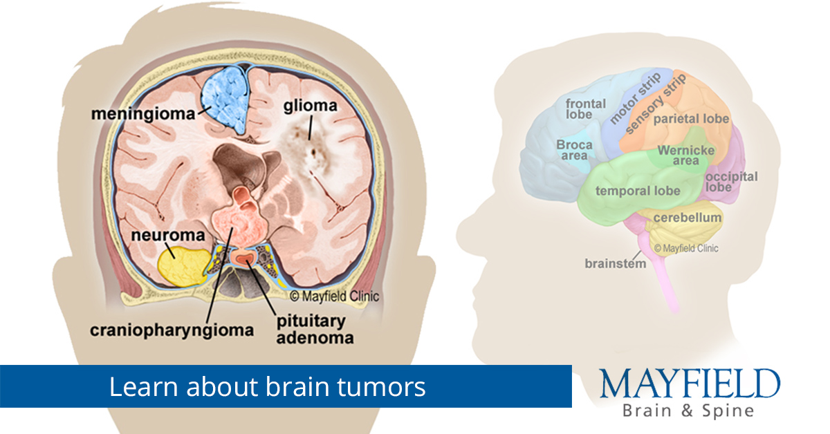 most-common-primary-brain-tumor