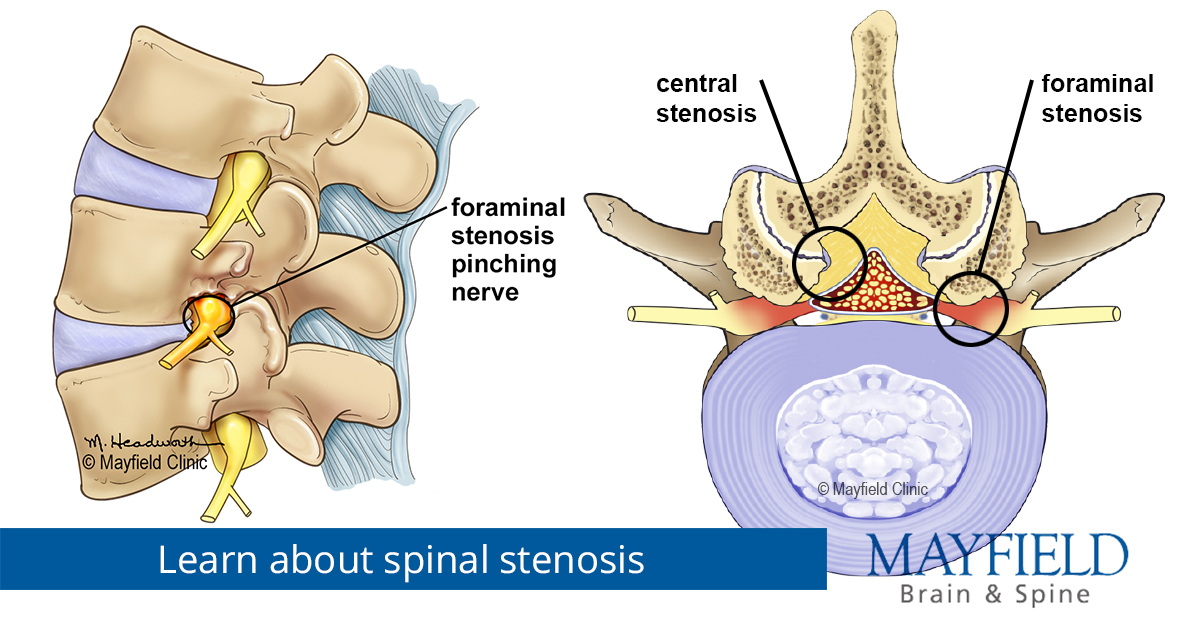 Spinal stenosis, diagnosis and treatments