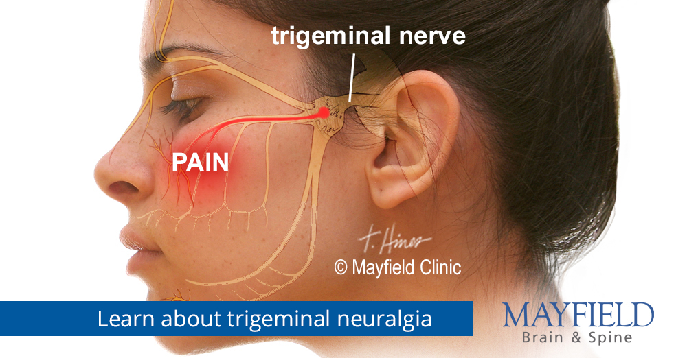 Facial Pain, Trigeminal Neuralgia Cincinnati, OH Mayfield, 43% OFF