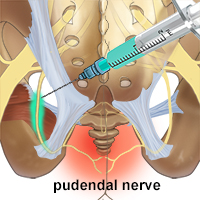 Peripheral nerve block injections